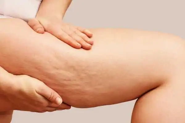 Image of woman showing leg with cellulite Birchills