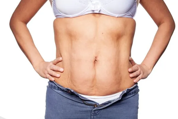 sagging skin on woman's stomach after weight loss injections Birchills
