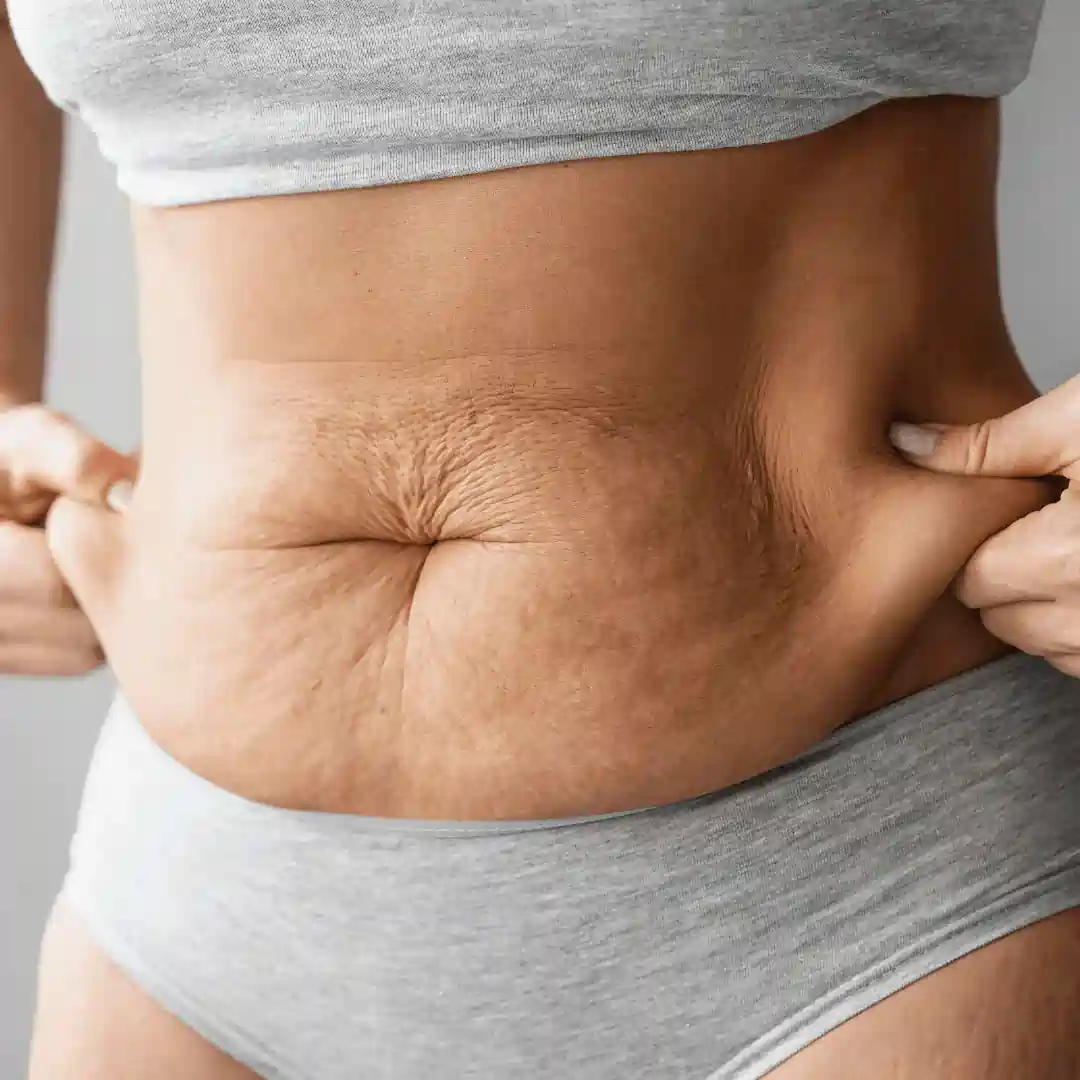 Is It Normal to Have Loose Skin After Pregnancy Birchills?